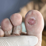 Diabetes, Foot Ulcer, Wound Management, Saskatchewan, Regina