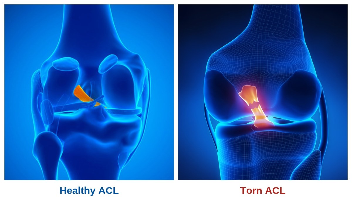 Two knees side by side. Left: a healthy ACL in the middle of the knee. Right: a torn ACL.