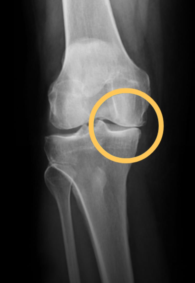 X-ray of a knee with osteoarthritis. The joint space on one side is narrow.
