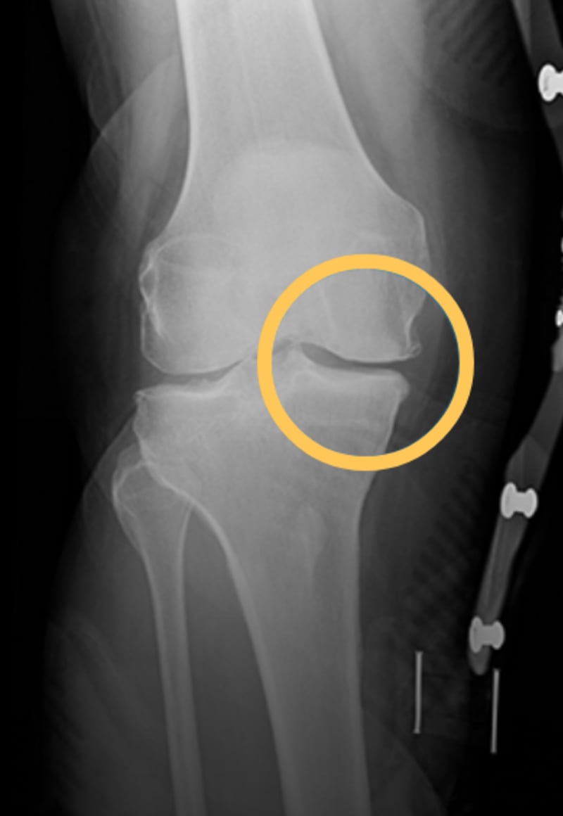 X-ray of the same knee in an unloader brace. The joint space opens up.