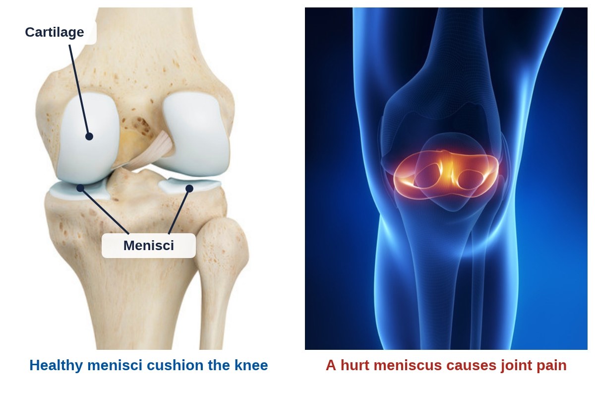 Left: front view of the knee with the cartilage and the two menisci labelled. Right: a knee with the menisci glowing to show meniscus pain.